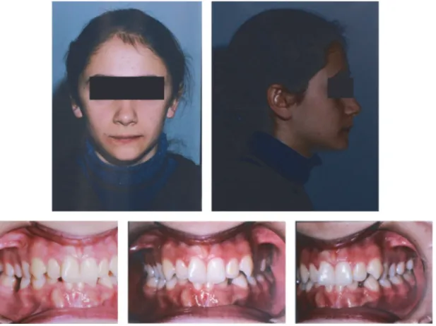Figure 1: Pretreatment extraoral and intraoral photographs of the patient.