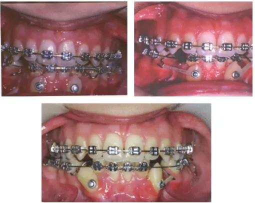 Figure 3: Elastic traction in different times of the treatment.