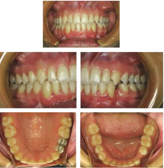Figure 4: Posttreatment intraoral photographs of the patient.