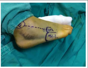 Figure 2. Lateral view of the displaced posterior calcaneal facet.
