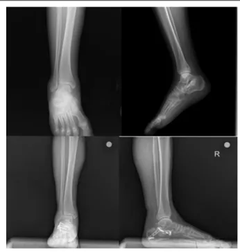 Figure 5. Pre- and postoperative AP and lateral X-rays of cannulated screw fixation.