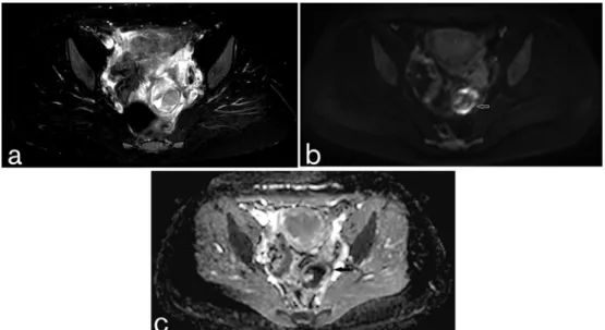 Figure 2. (a–c) EP at parauterin region (a) transverse fat-saturated T 2  TSE, (b) DWI and (c) ADC map show an enhancing thick- thick-walled cyst with “ring of restriction”.  ADC, apparent diffusion coefficient; DWI, diffusion-weighted imaging; EP,  ectopi