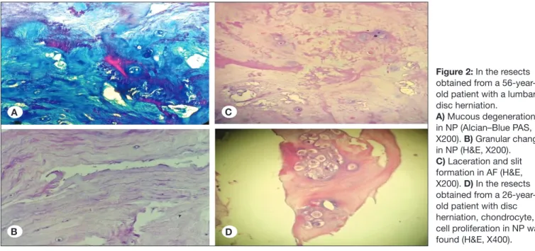 Figure 2: In the resects  obtained from a  56-year-old patient with a lumbar  disc herniation