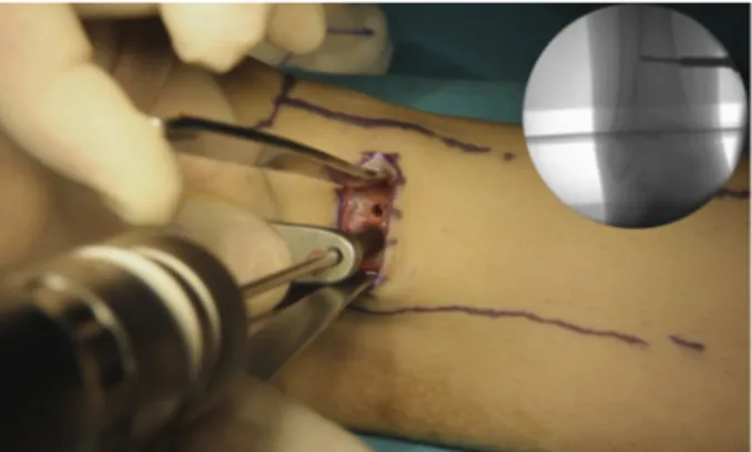 Fig. 1. Skin incision could be either transverse or longitudinal. Fig. 2. The osteotomies were performed using multiple drill hole technique.