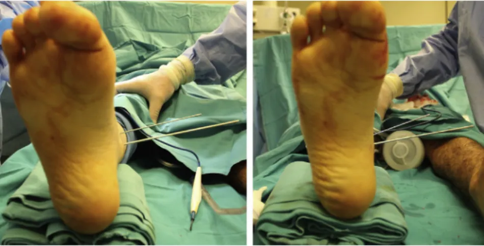 Fig. 4. Advancement of 120  pediatric proximal femur locking plate.