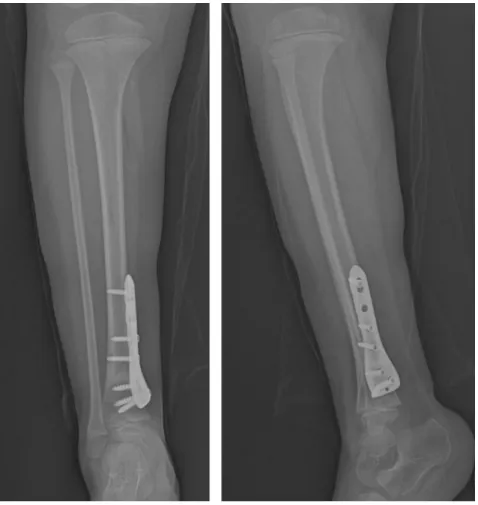 Fig. 6. Follow up radiographs show level of osteotomy and bone fusion.