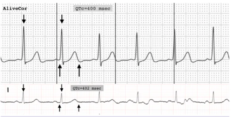 Figure 1.  The electrocardiography recordings obtained using  smartphone electrocardiography and 12-lead  electrocardio-graphy from the same patient.