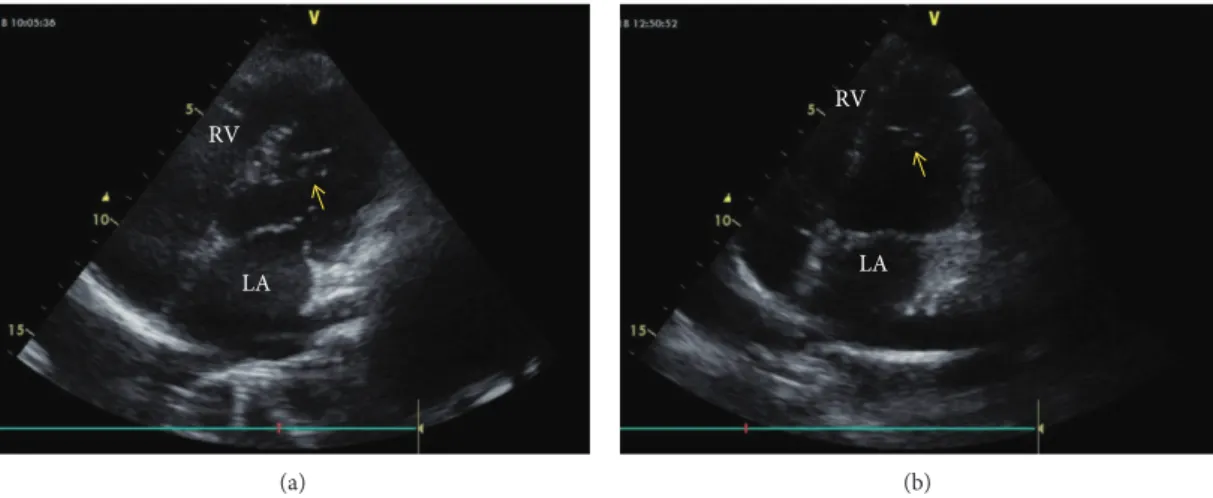 Figure 3: B-mode echocardiographic image from the father (a) and his daughter (b). (a) and (b) Modiﬁed apical four chamber view by B-mode recording