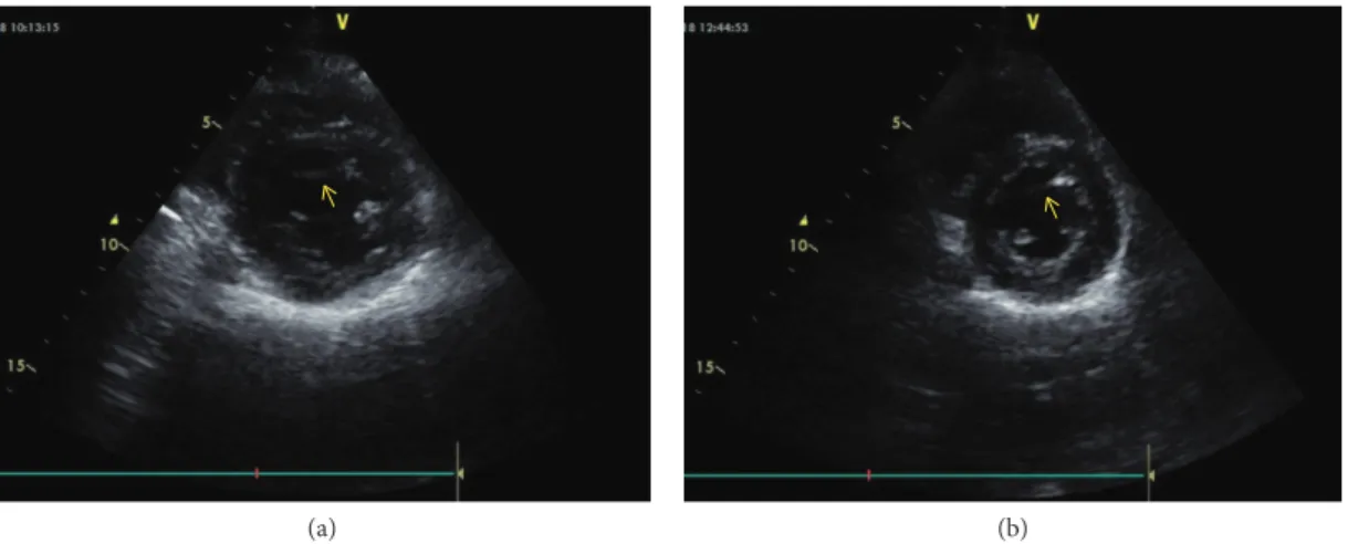 Figure 4: B-mode echocardiographic image from the father (a) and his daughter (b). (a) and (b) B-mode image from the short axis.