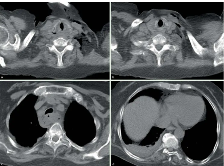 Fig. 3 Axial noncontrast-enhanced computed tomography images after the procedure showed free air bubbles in the left cervical region (a, b), and the peri- peri-esophageal (c) and right paracardiac (d) spaces.