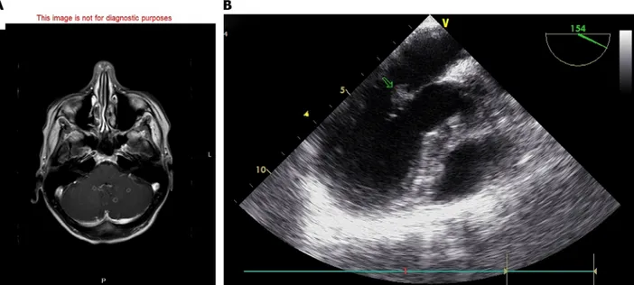 FIGURE 2. Lung window of contrast-enhanced chest CT depicts multiple centrilobular nodules randomly distributed in both lungs.