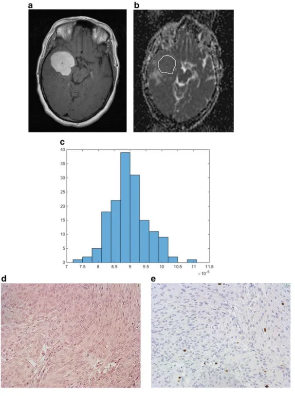 Figure 1. ADC histogram analysis parameters of a grade 1 meningioma. a. T1 weighted image after intravenous administration of contrast medium showing a right temporal meningioma