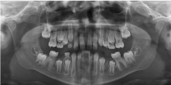 Fig. 3 Panoramic radiograph. Note congenitally missing mandibular permanent central incisors can be seen