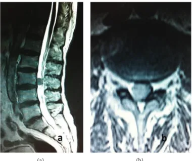 Figure 1: (a) Preoperative sagittal T2-weighted lumbar MRI demonstrated well-circumflanced, hypointense lesion anterior to L3 vertebrae.