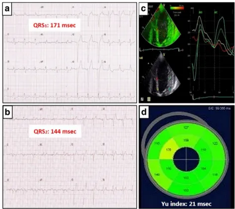 Fig. 4 Patient having a CRT- CRT-induced QRS prolongation. a Baseline QRS interval is 177 milliseconds