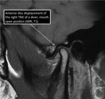 Table  1.  Demographics  of  the  SCUBA  divers  with  a  definite  temporomandibular  disorder  (TMD),  VAS  scoring  of  TMD  symptoms  (on  a  scale  from  0  to  10)  and  TMD  physical  signs  (on  a  scale  from  0  to  3) [Pt, patient;  CMAS,  divin