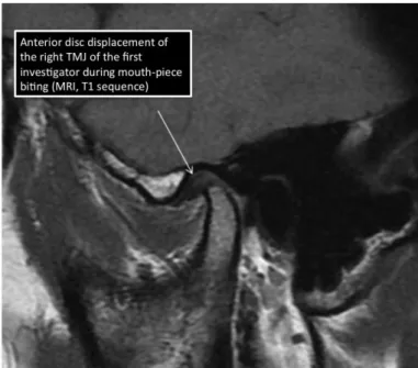Figure  4.    The  anterior  disc  replacement  is  seen  more  often  than it is expected