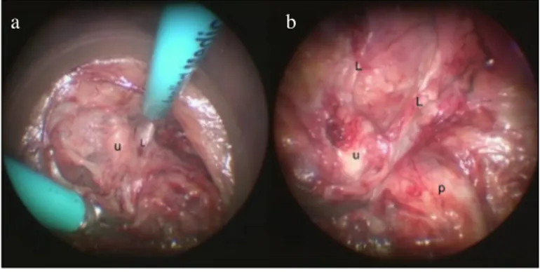 Figure 3. a, b. (a) Prostatic apical dissection; u: Urethra; L: 