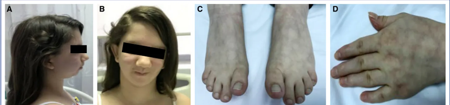 Figure  1.  (A) Typical dysmorphic facial features of Andersen-Tawil syndrome: microretrognathia, and (B)  broad  forehead; 