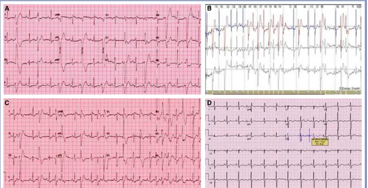 Figure 2. (A) Surface electrocardiogram recorded at admission showed bigeminy and bidirectional premature ventricular con- con-tractions (PVCs); (B) Bidirectional ventricular tachycardia was seen on Holter monitoring; (C) Polymorphic PVCs became visible  d