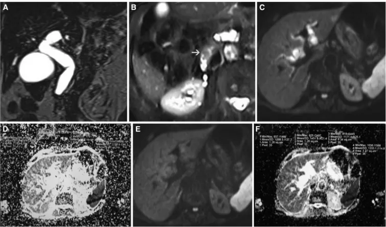 Figure 1. Ampullary carcinoma in a 52-year-old man. (A) Magnetic resonance cholangiopancreatography shows dilatation of gallbladder with abrupt cutoff of common bile duct