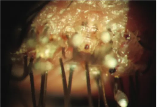 Figure 1: Slit-lamp photo; multiple lice and nits anchored at the eyelashes (pretreatment).