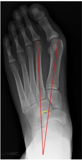 Fig. 2. Plain radiograph showing intermetatarsal angle of the hallux.