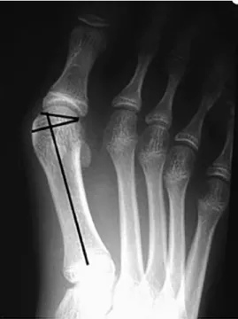 Fig. 4. Intraoperative photograph showing insertion of the bioabsorbable pin across the osteotomy site after bunionectomy.