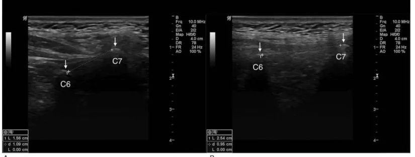 Figure 3. Tip-to-tip distance between C6-C7 spinous processes in upright position (A) and maximal cervical forward ﬂexion (B)