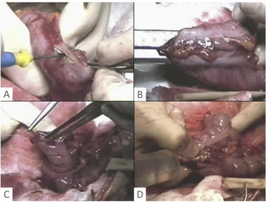 Fig. 1. Conﬁguration of colonic j-pouch: an incision is created on the antimesenteric side of the colon at 6e7 cm from the distal edge (A), a 4e6 cm long anastomosis is constructed with a linear stapler (B), the tip of j is closed with hand-sewn sutures or
