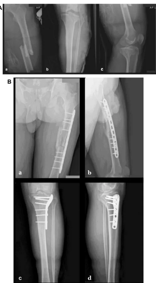 Figure 2 (A) Preoperative X-ray images of the 53-year-old male patient with Blake and McBryde Type 2 fracture; (B) the X-ray images of femur (healed) and tibia (healed) at the postoperative 4.5 th month