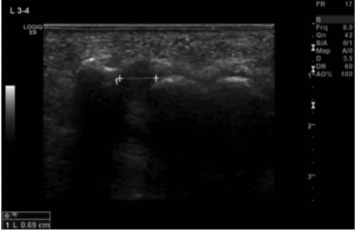 Fig. 1. Coronal ultrasound image showing a well-circumscribed, ovoid, and hypoechoic (relative to adjacent muscle) mass in the third intermetatarsal space of the left foot, consistent with Morton’s neuroma.