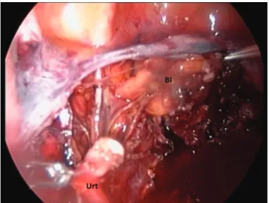 Figure  2. The transected edges of the ureter at the level of left  cardinal ligament were seen