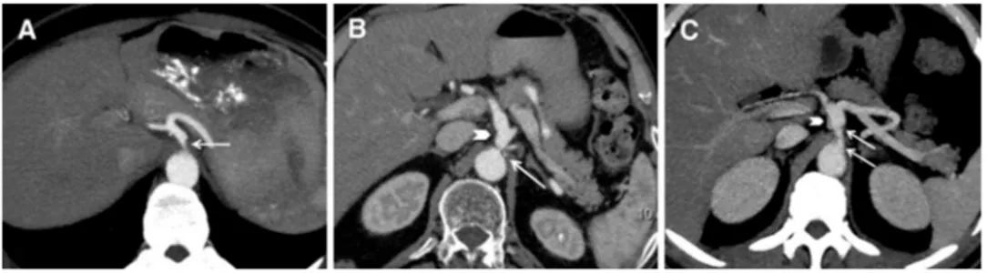 Figure 1. Axial maximum intensity projection images of different patients demonstrate the characteristic narrowing of celiac artery (arrows) secondary to median arcuate ligament compression, (A) high-grade stenosis in short segment without poststenotic dil