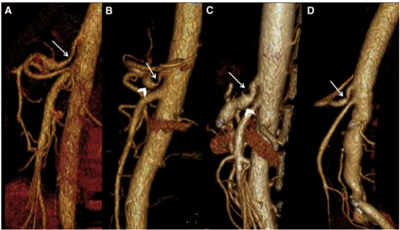 Figure 3. Sagittal 3-D volume rendering images of different patients (A-D) demonstrate focal narrowing of the proximal celiac axis caused median arcuate ligament (arrows) and poststenotic dilatation (arrowheads)