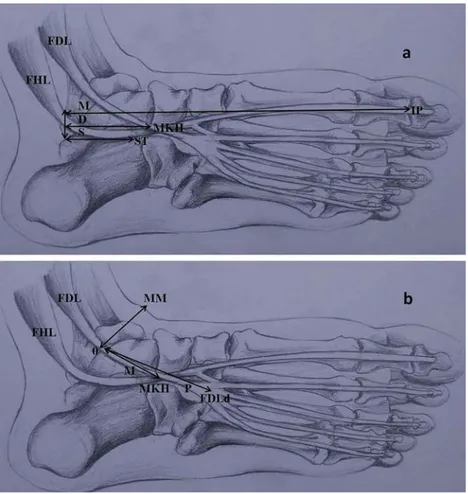 Fig. 3. The illustration shows classiﬁcation of connections between tendons. Type 1, one slip from FHL to FDL; Type 2, crossed connection; Type 3, one slip from FDL to FHL; Type 4: