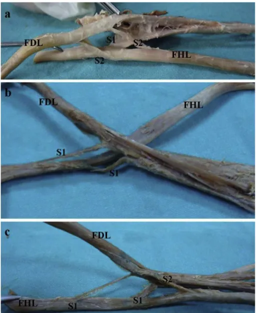 Fig. 5. The photographs: 5a shows one slip from FHL to FDL (S1) and two slips from FDL to FHL (S2), 5b shows two slips from FHL to FDL (S1) and 5c shows two slips from FHL to FDL (S1) and one slip from FDL to FHL (S2).