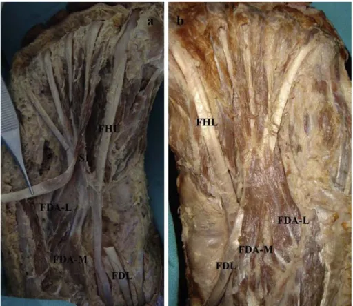 Fig. 9. The photograph 9a shows half of the medial head composed of tendinous ﬁbers and attachments of FDA to FHL slip and also 9b shows attachment of FDA to superﬁcial surface of FDL