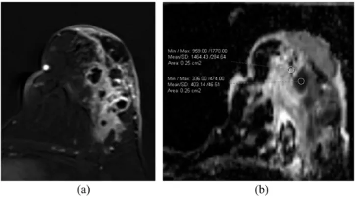 Figure 1. (a, b) Breast carcinoma. Subtraction image (a) shows enhanced mass with irregular borders