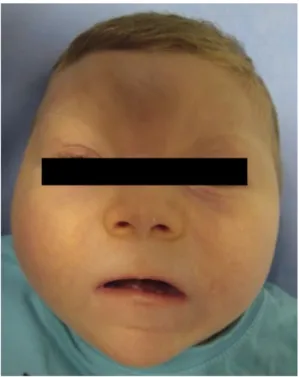 Fig. 3. Fully inserted cochlear implant is shown by transorbital X-ray.