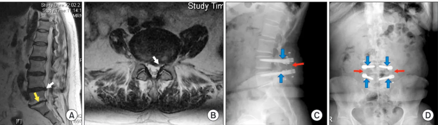 Fig. 2. A 61-year-old female patient complained of back pain and left sciatica. She had an approximate 20-year history of back pain attacks