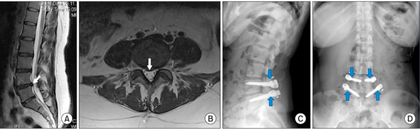 Fig. 4. A 47-year-old female patient had severe back pain attacks for a total of 8 years with 4 severe attacks occurring in the most recent year