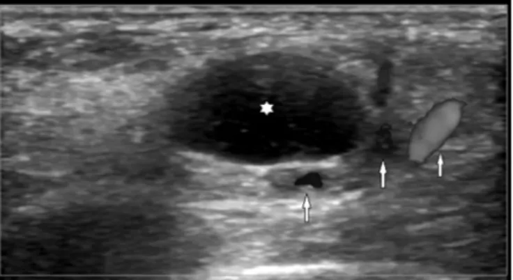 Fig. 2. Well circumscribed, anechoic cystic lesion (asterisk) adjacent to the posterior tibial artery and vein (arrows) in the medial foot.