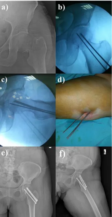Figure 1: Radiographs of a 52 year-old woman with a left femoral neck  fractures (Garden III fracture): Preoperative (a), intraoperative (b-c-d)  and postoperative (e-f) radiographs 