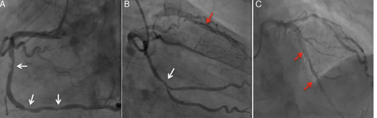 Figure 1: Coronary angiography showing stenosis of the right coronary artery (A) and the second marginal branch of the left circumﬂex artery (B, white arrow)