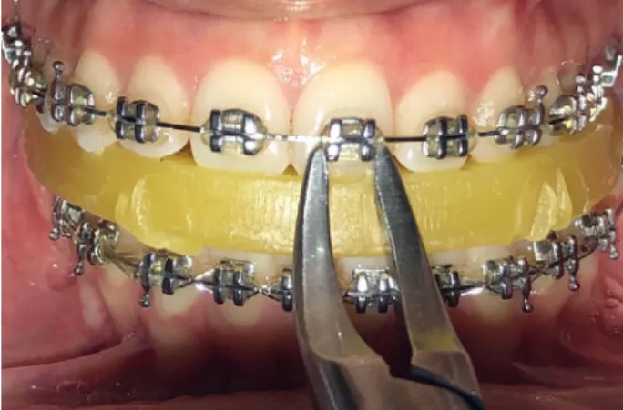 Figure 3- Intraoral photograph of debonding with soft acrylic bite  wafer