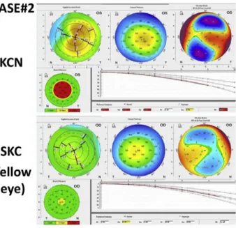 Figure 2. Samples of rotating Scheimpflug imaging and Belin- Belin-Ambrosio display scans of patients with keratoconus (KCN) in 1 eye and subclinical keratoconus (SKC) in the fellow eye