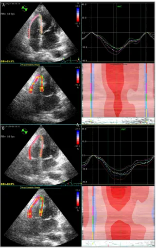 Table 3. Standard echocardiographic and strain imaging values before, on the last day, and one month after RT
