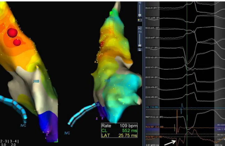 Fig. 1 Catheter ablation of right ventricular outflow tract (postero-lateral) premature ventricular complexes and activation mapping using the EnSite Velocity system