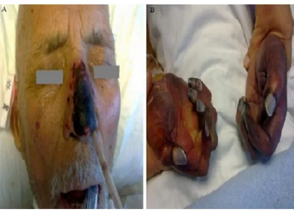 Fig. 1 – Clinical appearance of acrocyanosis on nose and hands with purple to black discoloration.